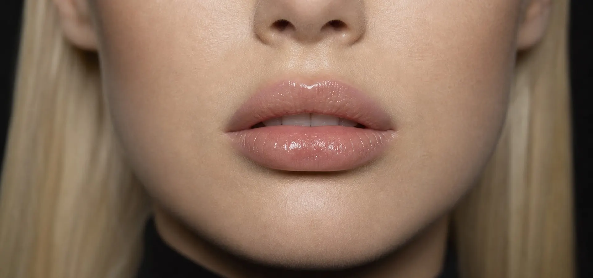 Lip Augmentation
