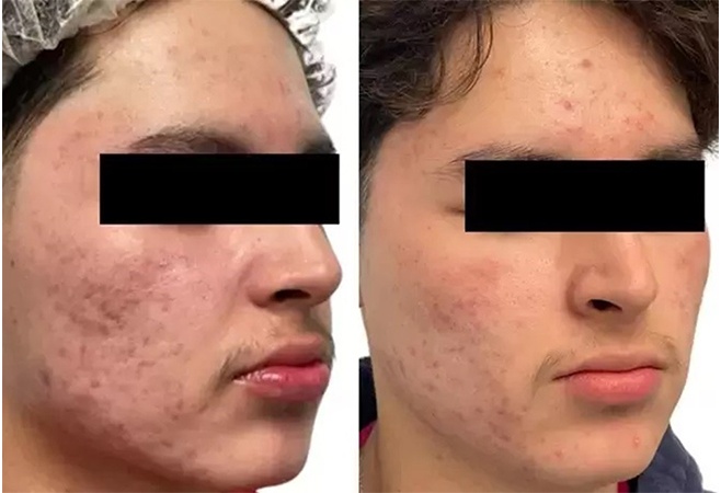 AquaFirmeXS before and after - oblique view