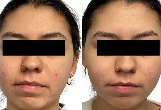 AquaFirmeXS before and after - frontal view