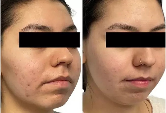 AquaFirmeXS before and after - oblique view