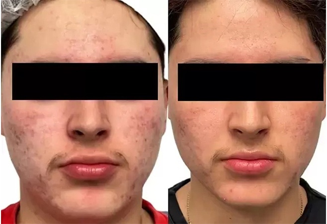 AquaFirmeXS before and after - frontal view