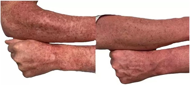 AquaFirmeXS before and after - frontal view