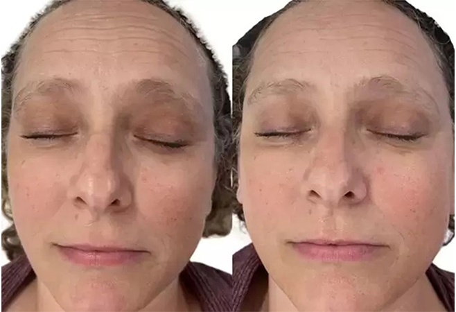 AquaFirmeXS before and after - frontal view