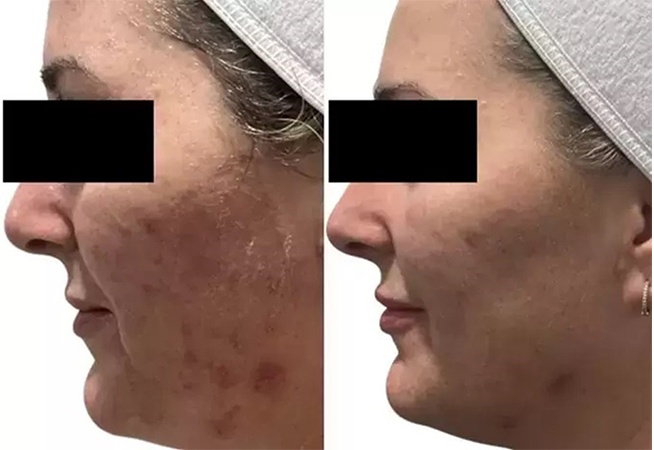 AquaFirmeXS before and after - profile view