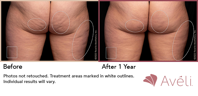 Avéli for Cellulite before and after - posterior view
