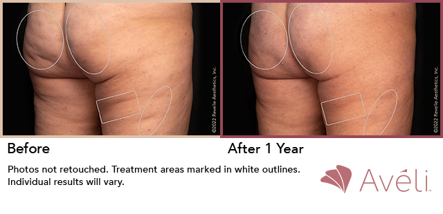 Avéli for Cellulite before and after - oblique view