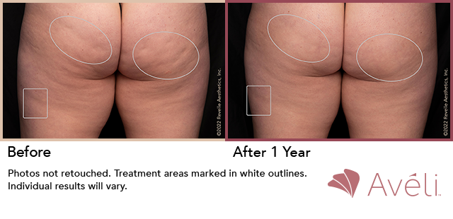Avéli for Cellulite before and after - posterior view