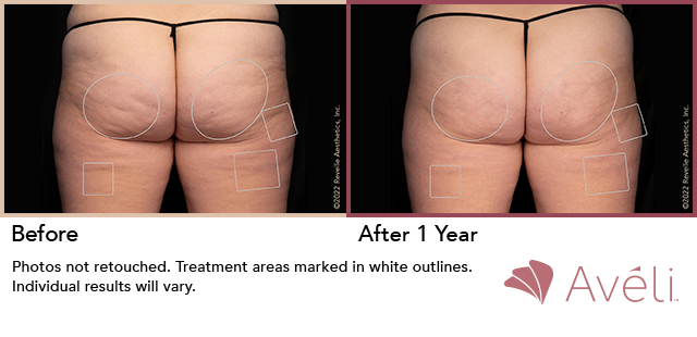 Avéli for Cellulite before and after - posterior view