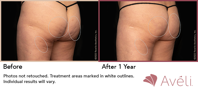 Avéli for Cellulite before and after - oblique view