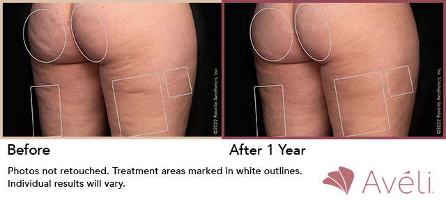 Avéli for Cellulite before and after - oblique view