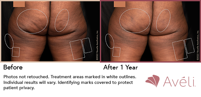 Avéli for Cellulite before and after - posterior view