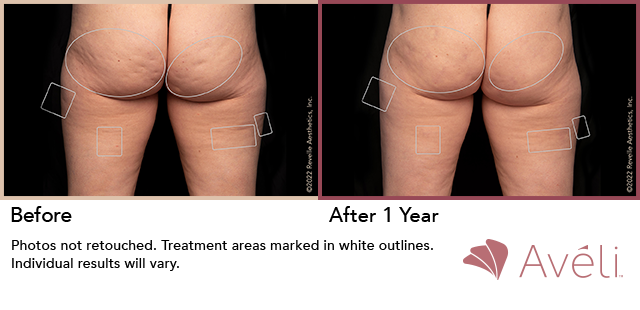 Avéli for Cellulite before and after - posterior view