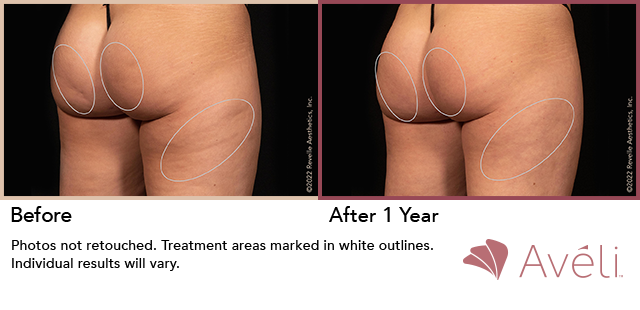 Avéli for Cellulite before and after - oblique view