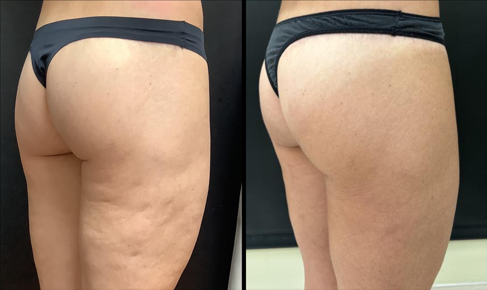 Avéli for Cellulite before and after - oblique view
