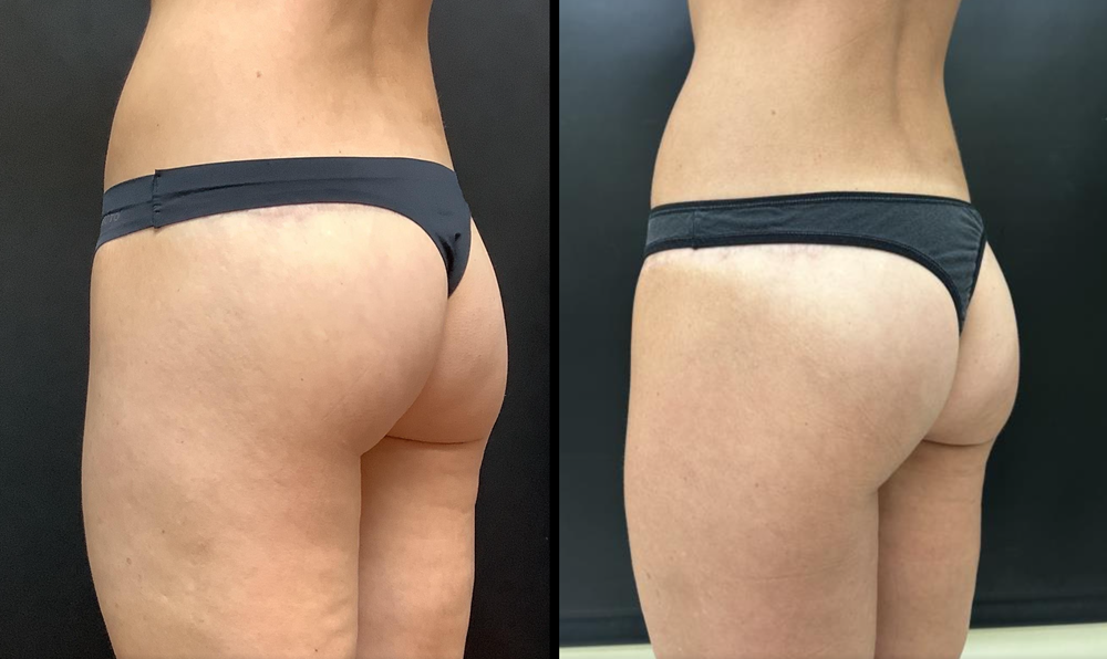 Avéli for Cellulite before and after - oblique view