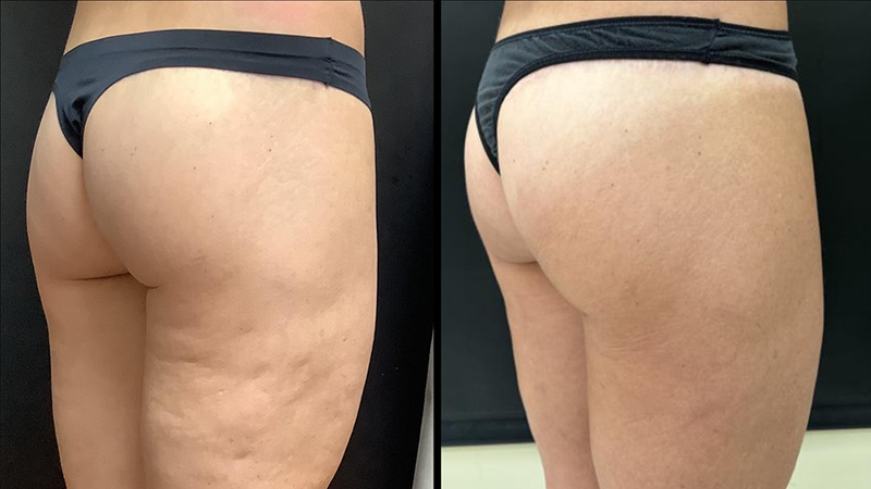 Avéli for Cellulite before and after - oblique view