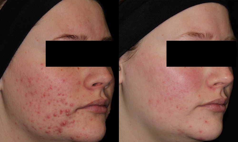 AviClear Acne Treatment before and after - oblique view