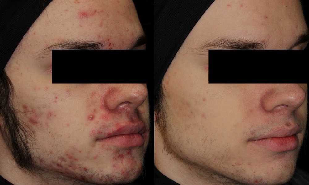 AviClear Acne Treatment before and after - oblique view