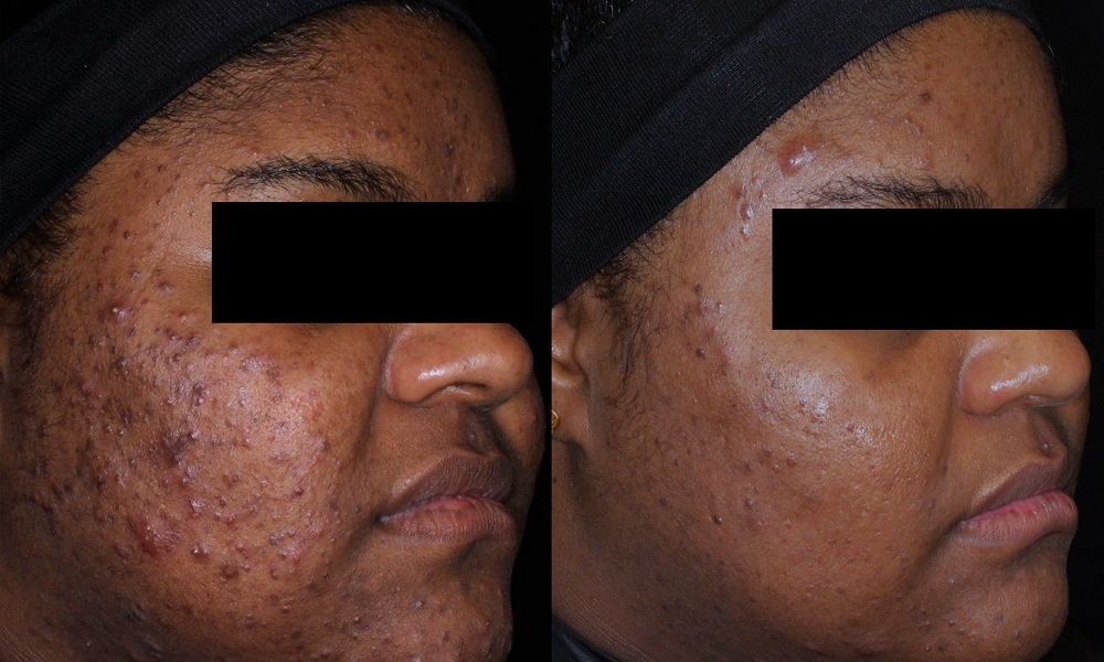 AviClear Acne Treatment before and after - oblique view