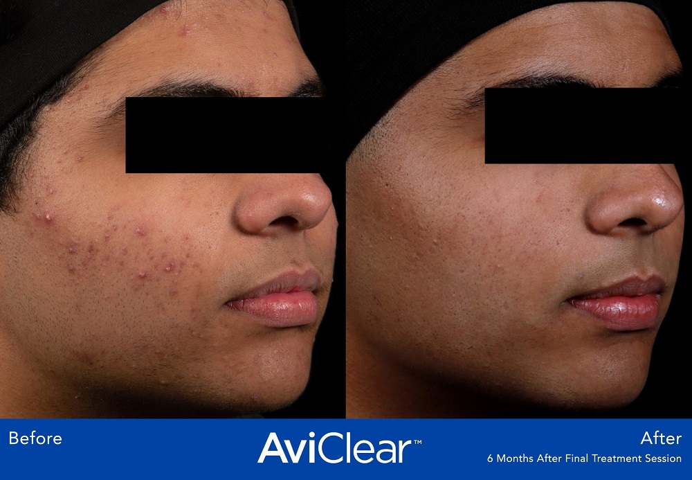 AviClear Acne Treatment before and after - oblique view