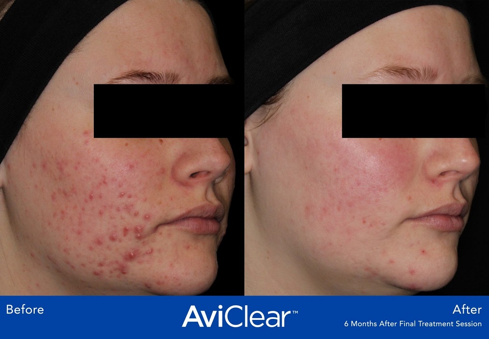 AviClear Acne Treatment before and after - oblique view