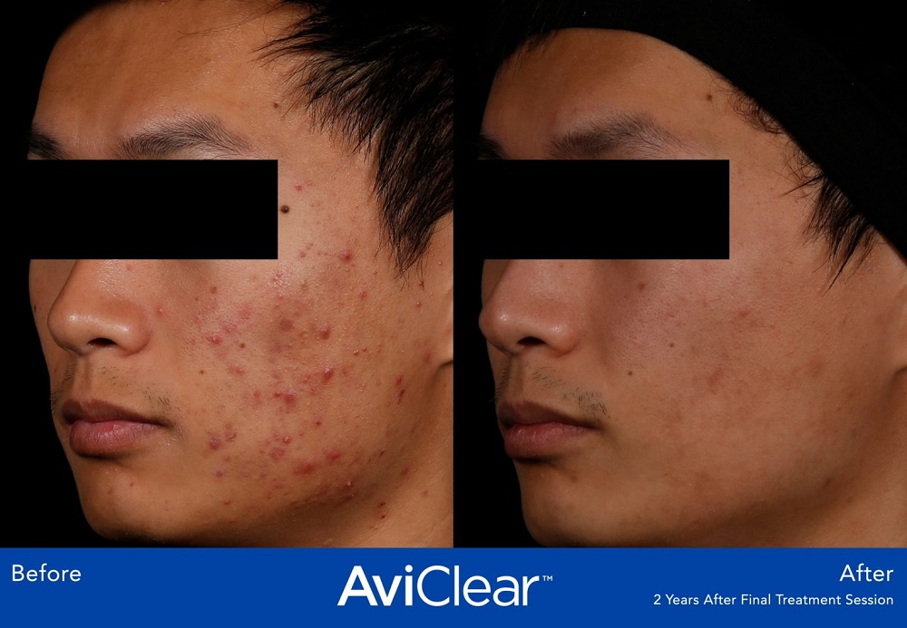 AviClear Acne Treatment before and after - oblique view