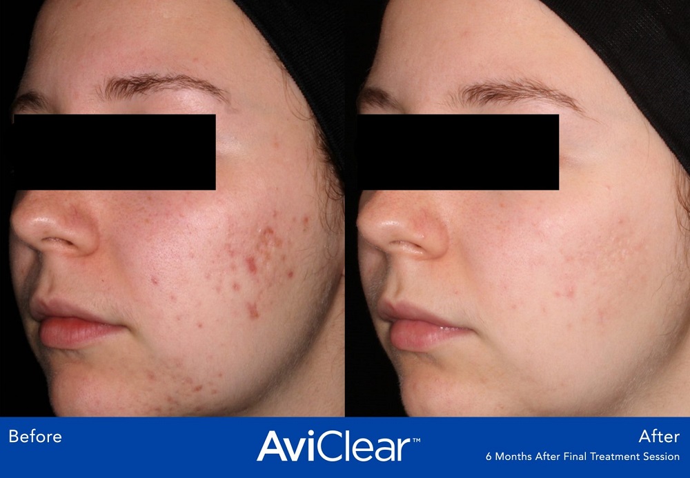 AviClear Acne Treatment before and after - oblique view