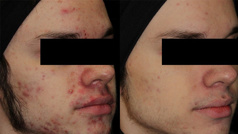AviClear Acne Treatment before and after - oblique view