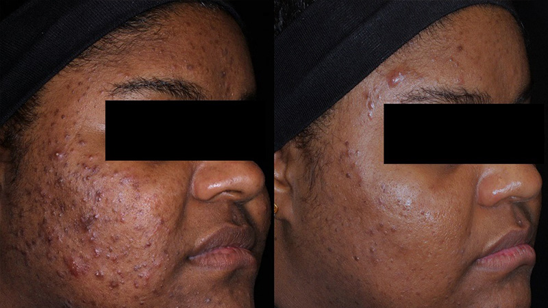 AviClear Acne Treatment before and after - oblique view