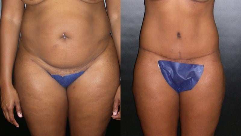 Body Lift before and after - frontal view