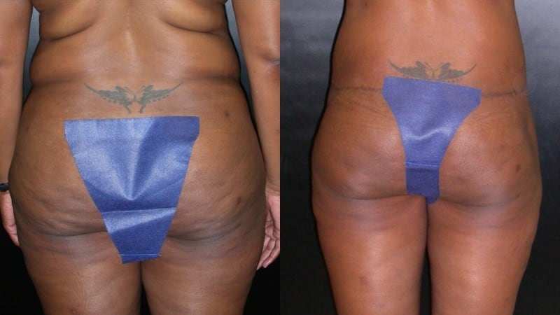 Body Lift before and after - posterior view
