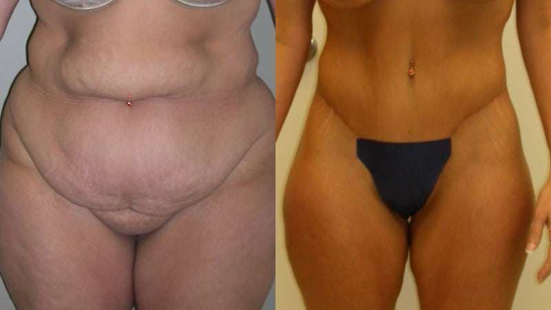 Body Lift before and after - frontal view