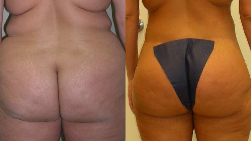 Body Lift before and after - posterior view
