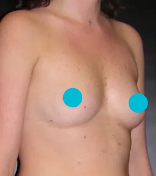 Breast Augmentation Before - Dr. Meghan McGovern, RenewalMD