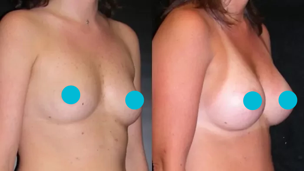 Breast Augmentation before and after - oblique view