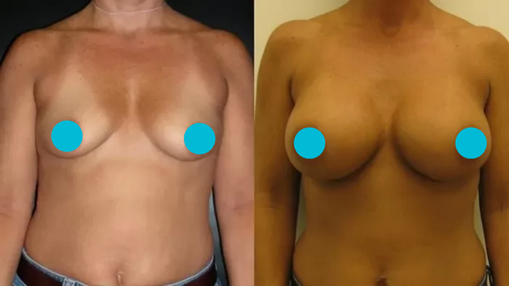 Breast Augmentation before and after - frontal view