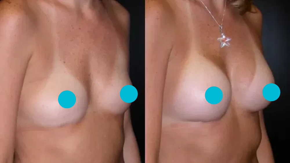 Breast Augmentation before and after - oblique view