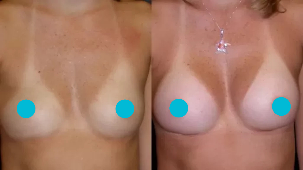 Breast Augmentation before and after - frontal view