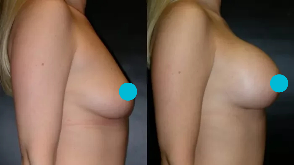 Breast Augmentation before and after - profile view