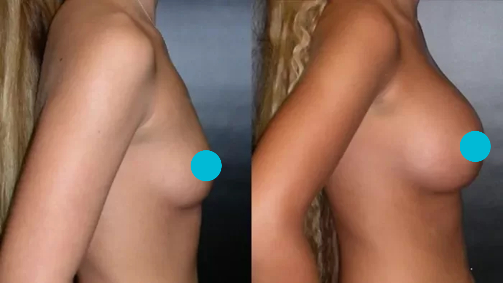 Breast Augmentation before and after - profile view