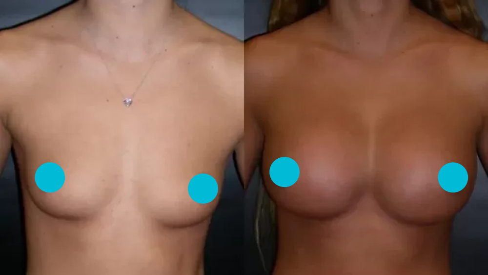 Breast Augmentation before and after - frontal view