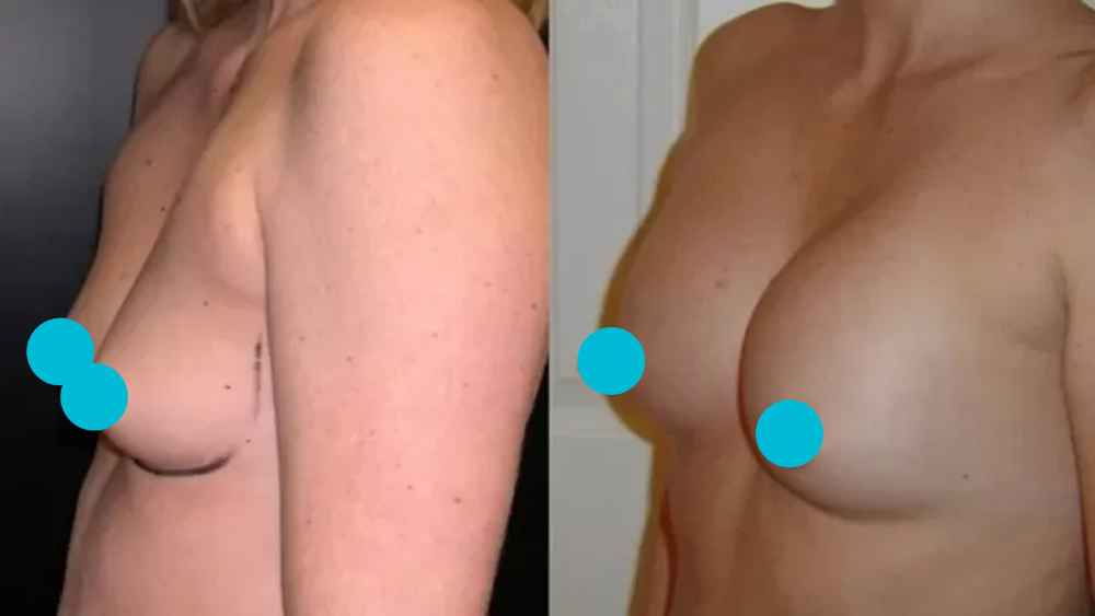 Breast Augmentation before and after - profile view