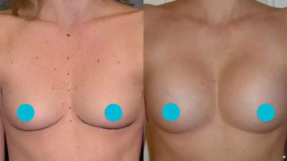 Breast Augmentation before and after - frontal view