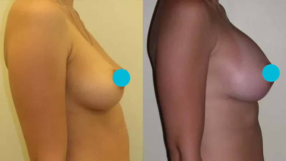 Breast Augmentation before and after - profile view