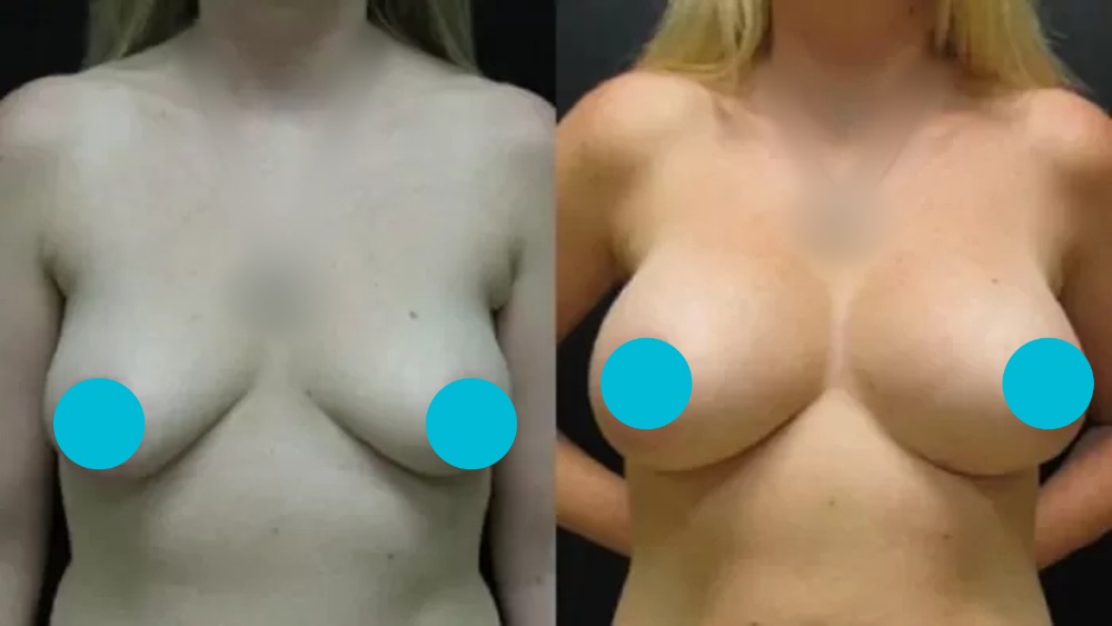 Breast Augmentation — Case 6