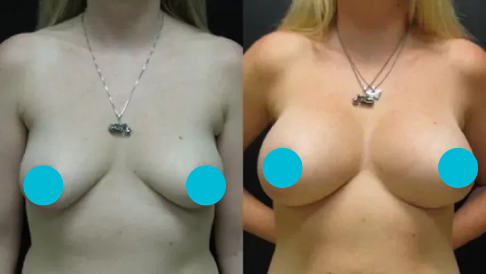 Breast Augmentation before and after - frontal view