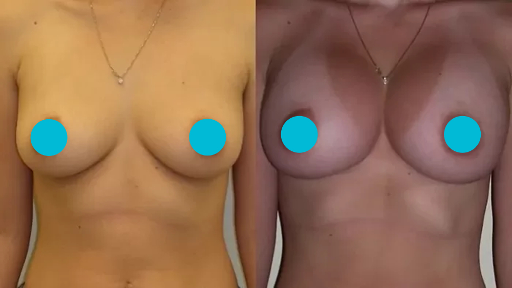 Breast Augmentation before and after - frontal view