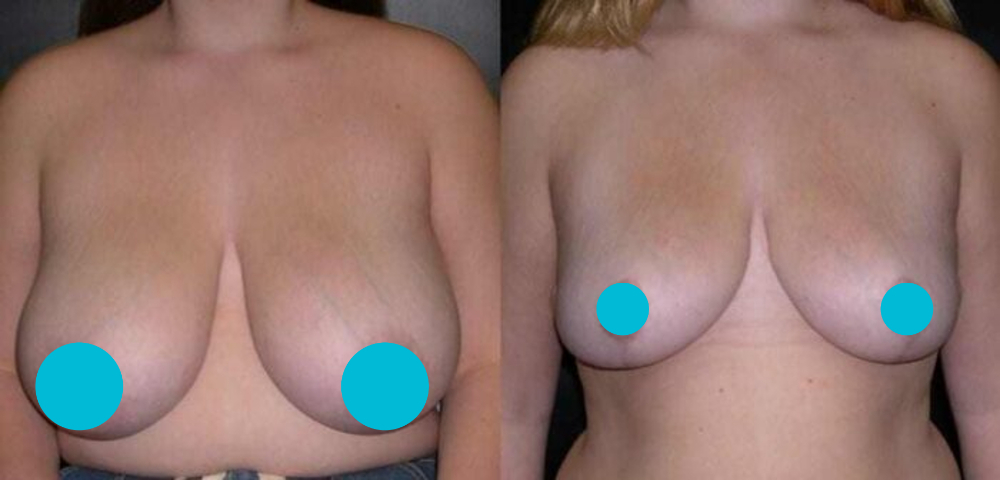 Breast Reduction before and after - frontal view