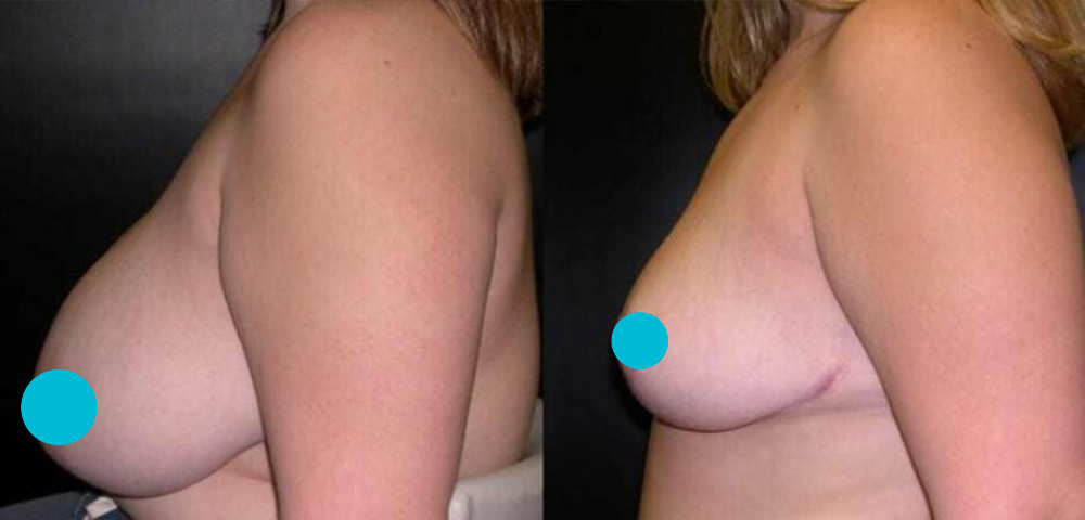 Breast Reduction before and after - profile view