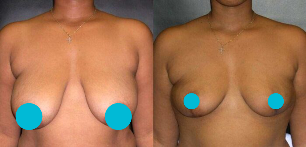 Breast Reduction before and after - frontal view